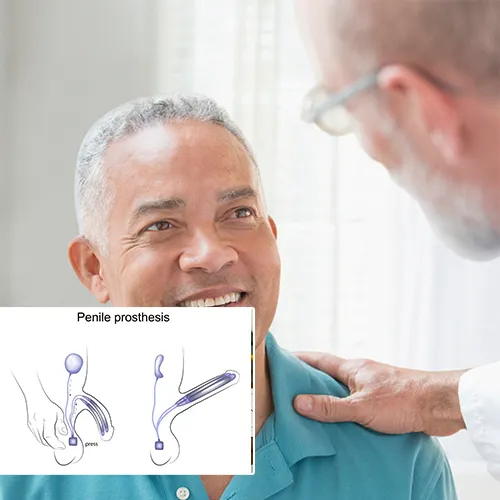Exercises For Penile Implant Recovery: Our Expertise Area